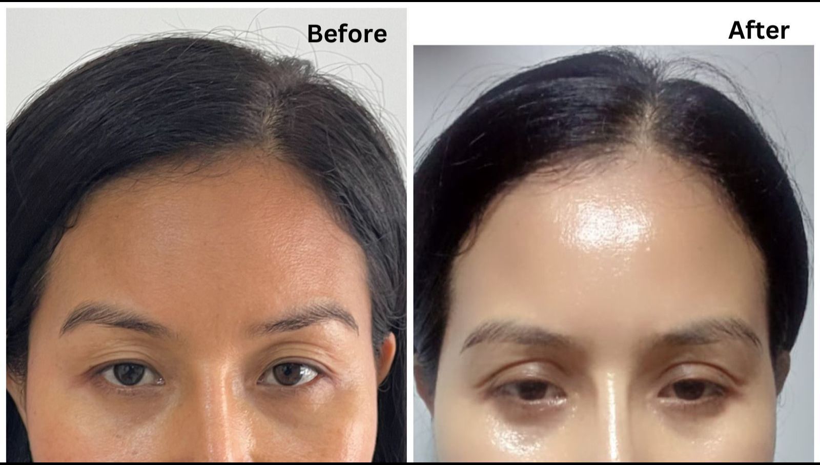 Blepharoplasty: If it makes you feel BEAUTIFUL, do it!