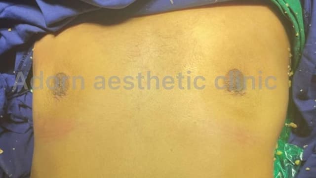 Gynecomastia: Restoring Confidence with male breast surgery