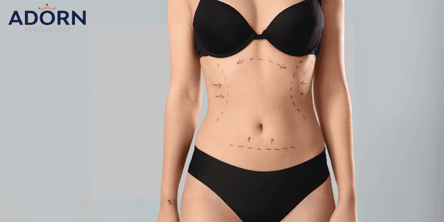 Liposuction in Ahmedabad: Cost, Procedure, & Recovery